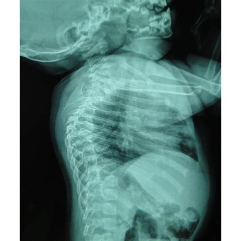 espina bifida rayos x